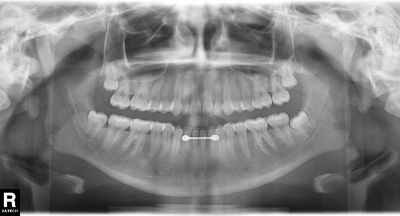 panoramic radiograph wisdom teeth Don Macalister Oral Surgeon-973
